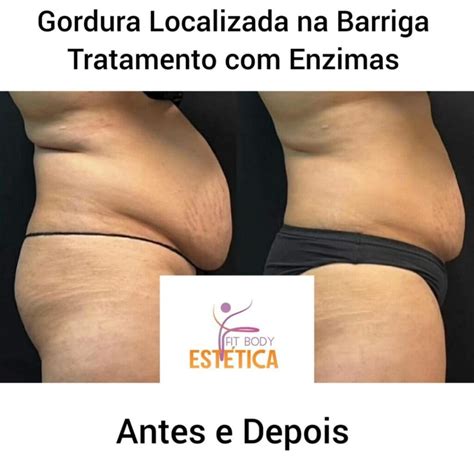 Gordura Localizada Na Barriga Tratamento Enzima