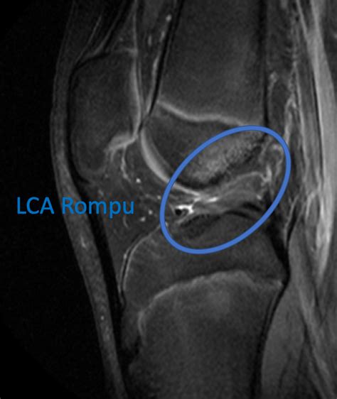 Rupture Du Ligament Crois Ant Rieur Causes Sympt Mes Et Traitements