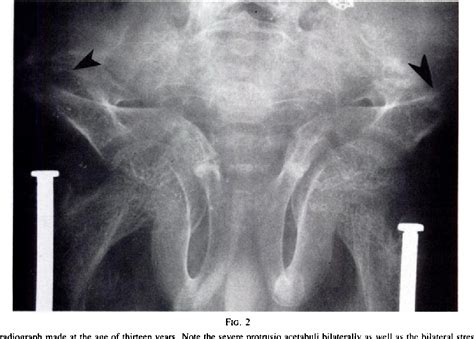 Figure From Obstruction Of The Colon Due To Protrusio Acetabuli In