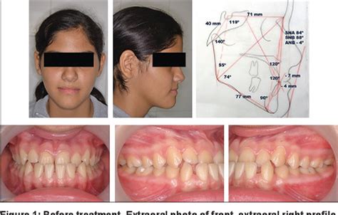 Figure 1 From Orthodontic Camouflage A Treatment Option A Clinical