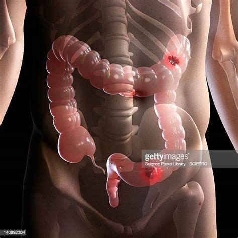 Large Intestine Cancer Stock Fotos Und Bilder Getty Images