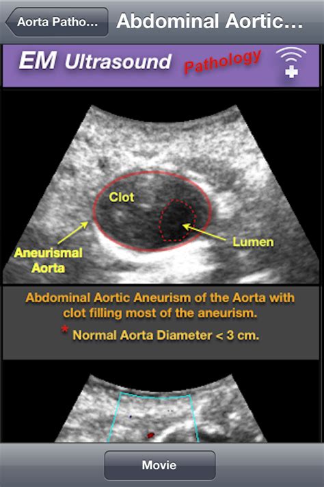 EM Ultrasound App for iPhone is a comprehensive reference for bedside scans