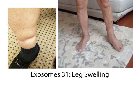 Exosomes Leg Swelling Recharge Biomedical