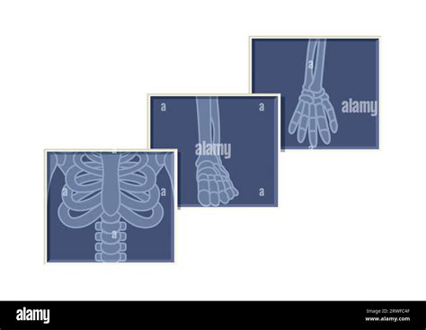 Chest Arm And Foot Skeleton Bones X Ray Radiology Vector Flat Design