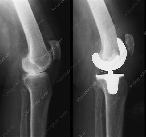 Knee Replacement X Ray