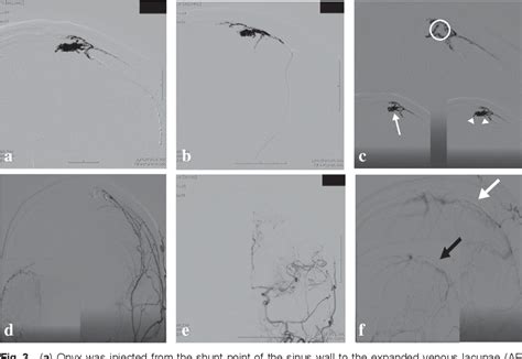 Figure From Dural Arteriovenous Fistula On The Wall Of The Superior