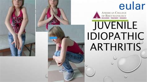 Juvenile Idiopathic Arthritis Ppt