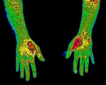 Using Infrared Imaging Before And After Shows Firefly Light Therapy