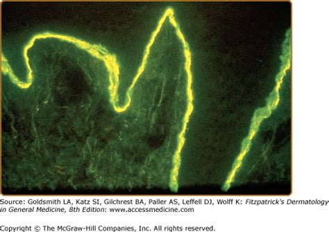 Epidermolysis Bullosa Acquisita | Plastic Surgery Key