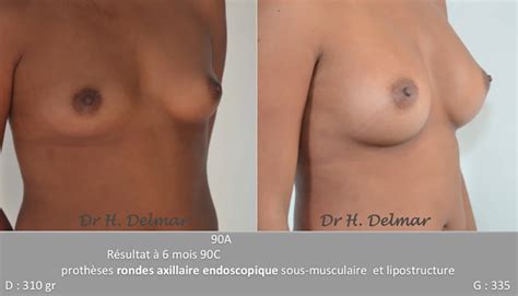 Clinique Del Mar Augmentation mammaire combinée