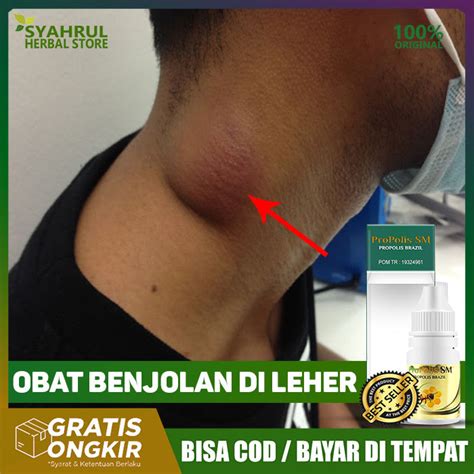 Obat Atasi Kelenjar Getah Bening, Obat Benjolan Limfoma, Obat Pembesaran Kelenjar Getah Bening ...