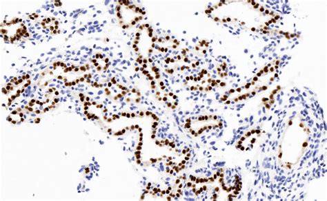 Pathology Outlines Nephrogenic Metaplasia