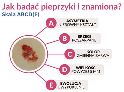 Czerniak Objawy Przyczyny I Leczenie Nowotwor W Sk Ry Centrum