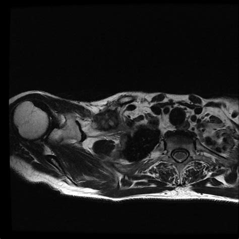 Plexus Brachial