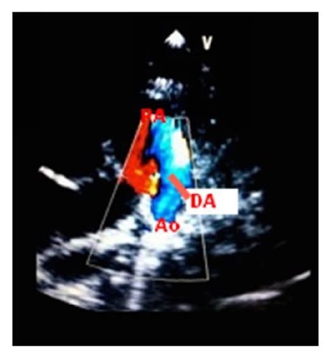 Transthoracic echocardiogram showing patent ductus arteriosus with flow... | Download Scientific ...