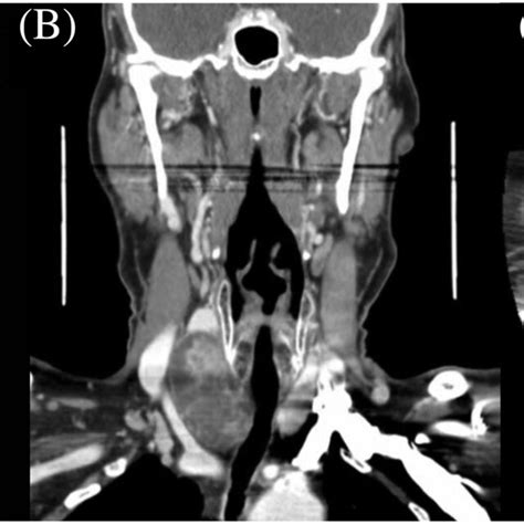 Representative Imaging Findings Of Atypical Parathyroid Adenoma A