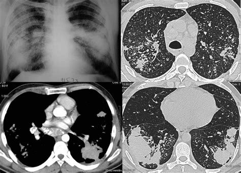 Silicosis Eggshell Calcification