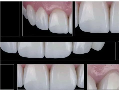 Direct Composite Veneers A Guide For Correct Layering Technique