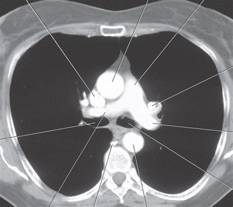 Sectional Anatomy Quiz Thorax Diagram Quizlet