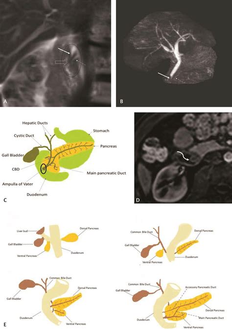 Hepatopancreatic Ampulla Duodenal Duct