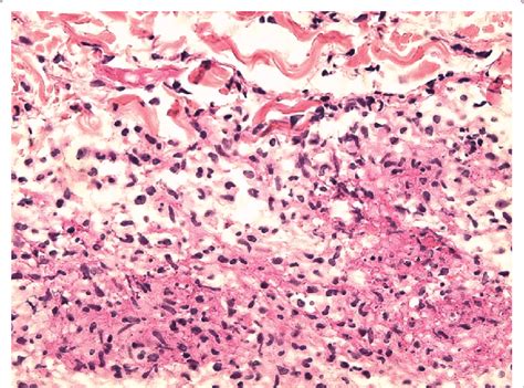 Septal Inflammatory Infiltrate Containing Lymphocytes Histiocytes