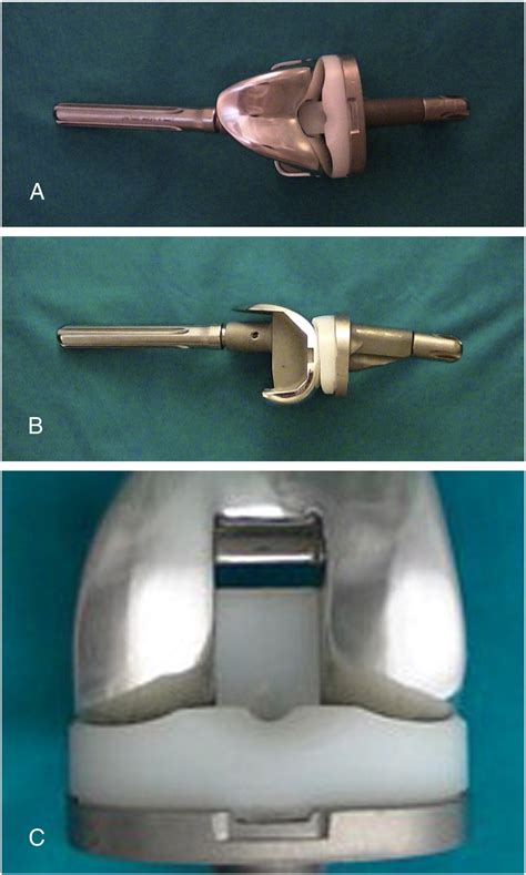 Results Of A Second Generation Constrained Condylar Prosthesis In