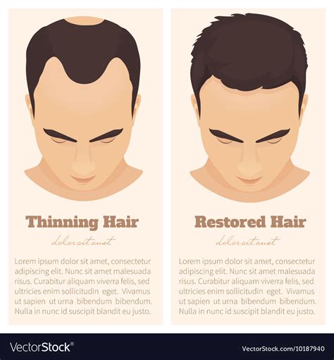 Male pattern baldness design template Royalty Free Vector