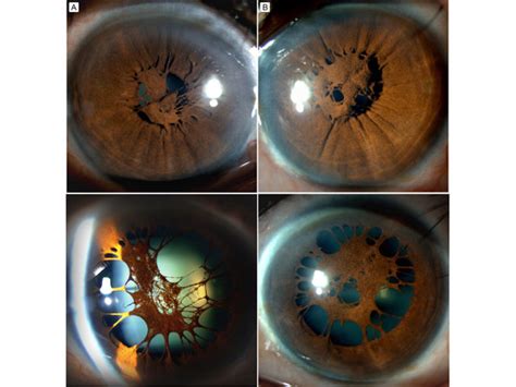 Accessory Iris Membrane Digital Journal Of Ophthalmology