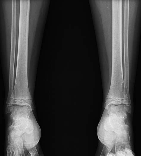 Radiopaedia Case Fibrous Cortical Defect Id 84090 Study 99337 Nc