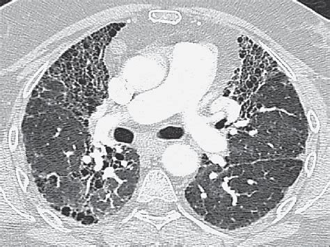 Patient With PH Complicating Stage IV Sarcoidosis The Scan Shows