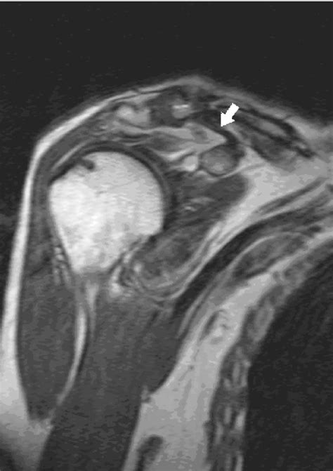 Acromioclavicular Joint Dislocation Semantic Scholar