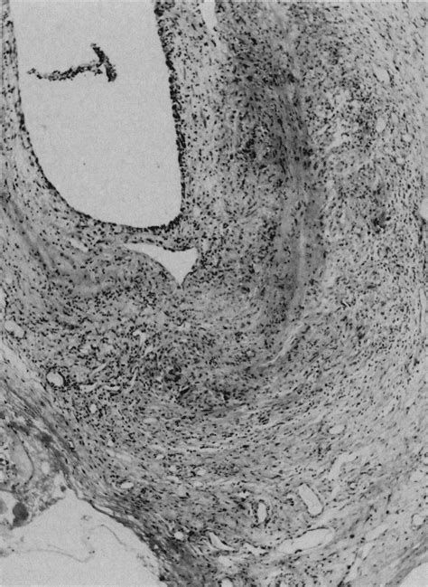 Case 35 1986 A 70 Year Old Woman With Fever Of Unknown Origin New