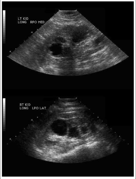 Renal Ultrasound Showing Multiple Bilateral Cysts Download Scientific