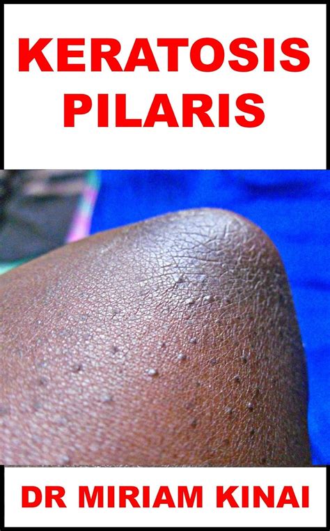 Dermatology Keratosis Pilaris Skin Diseases Book 41 Kindle Edition By Kinai Dr Miriam