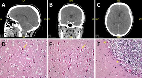 Anoxic Brain Injurya B C Postmortem Head Ct Showing Diffuse Brain Download Scientific Diagram