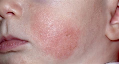 Baby eczema: causes, symptoms, treatments and creams - BabyCenter Canada