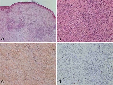 Densely Packed Monomorphic Plump Spindle Cells Arranged In A