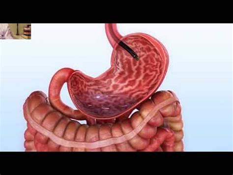 Gastroplastia Endosc Pica O Dr S Rgio Barrichello Youtube