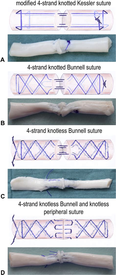 Biomechanical Analysis Of Flexor Tendon Repair Using Knotted Kessler