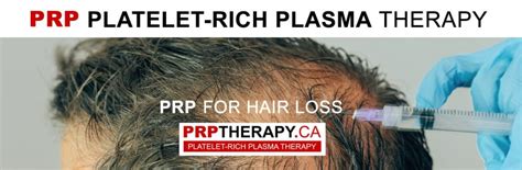 PRP hair treatment cost – microneedling with PRP – PRP before and after ...