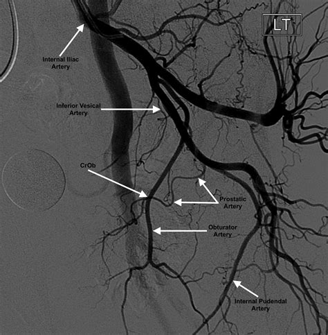 Crossing Obturator Sign Angiographic Feature To Aid Prostatic Artery