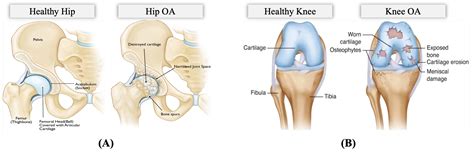 Informatics Free Full Text OA Pain Sense Machine Learning