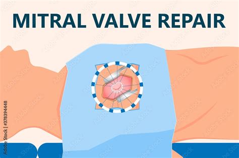 Cath Lab Atrial Septal Defect Tetralogy Of Fallot Patent Foramen Ovale