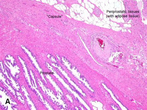 American Urological Association Prostatic Capsule And Periprostatic