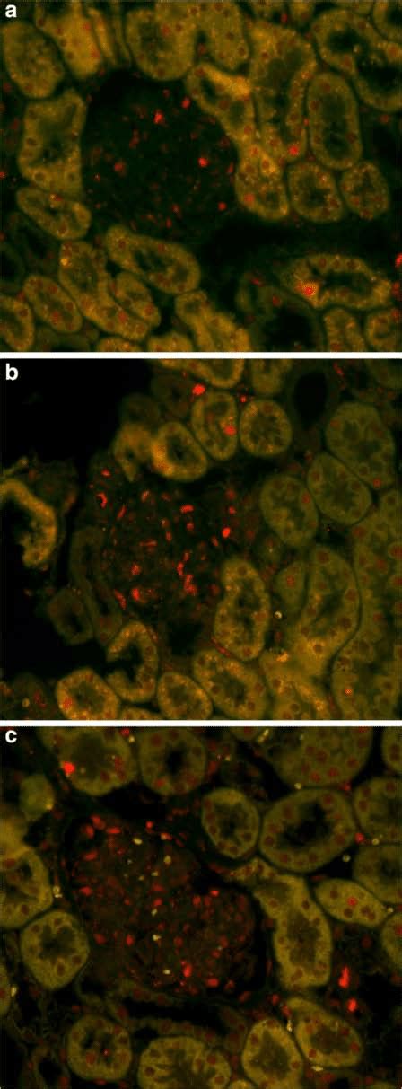 Double Immunofluorescent Staining Of Cd Red And Ki Green A