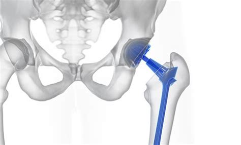 Cirugía de Protesis de cadera Cómo se realiza la operación y cómo es