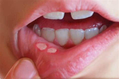 Hjem Rettsmidler For Eliminere Canker S R Labial Brann Eller