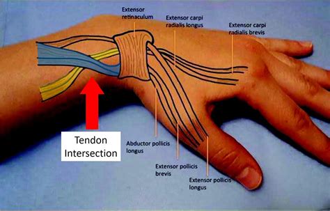 Extensor Tendonitis Wrist