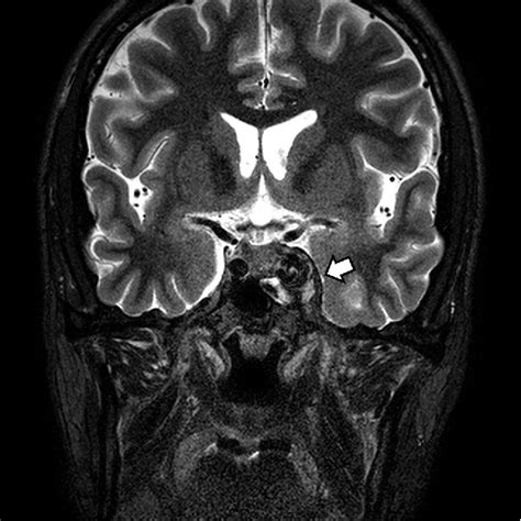 Figure 1 From Thin Section MR Imaging For Carotid Cavernous Fistula