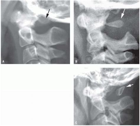 The Pediatric Cervical Spine Radiology Key